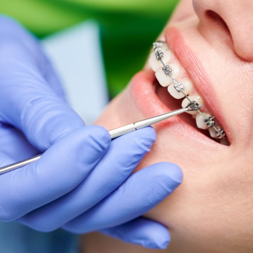 ortodoncia-fija-brackets-clinica-dental-nagua