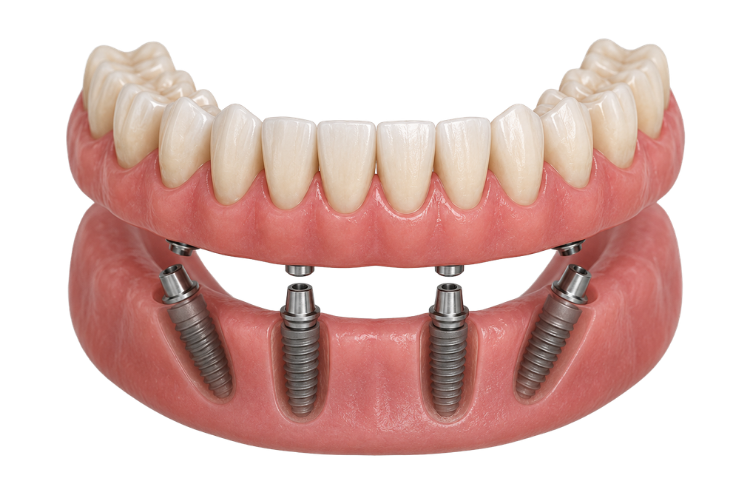 Implantes All on 4