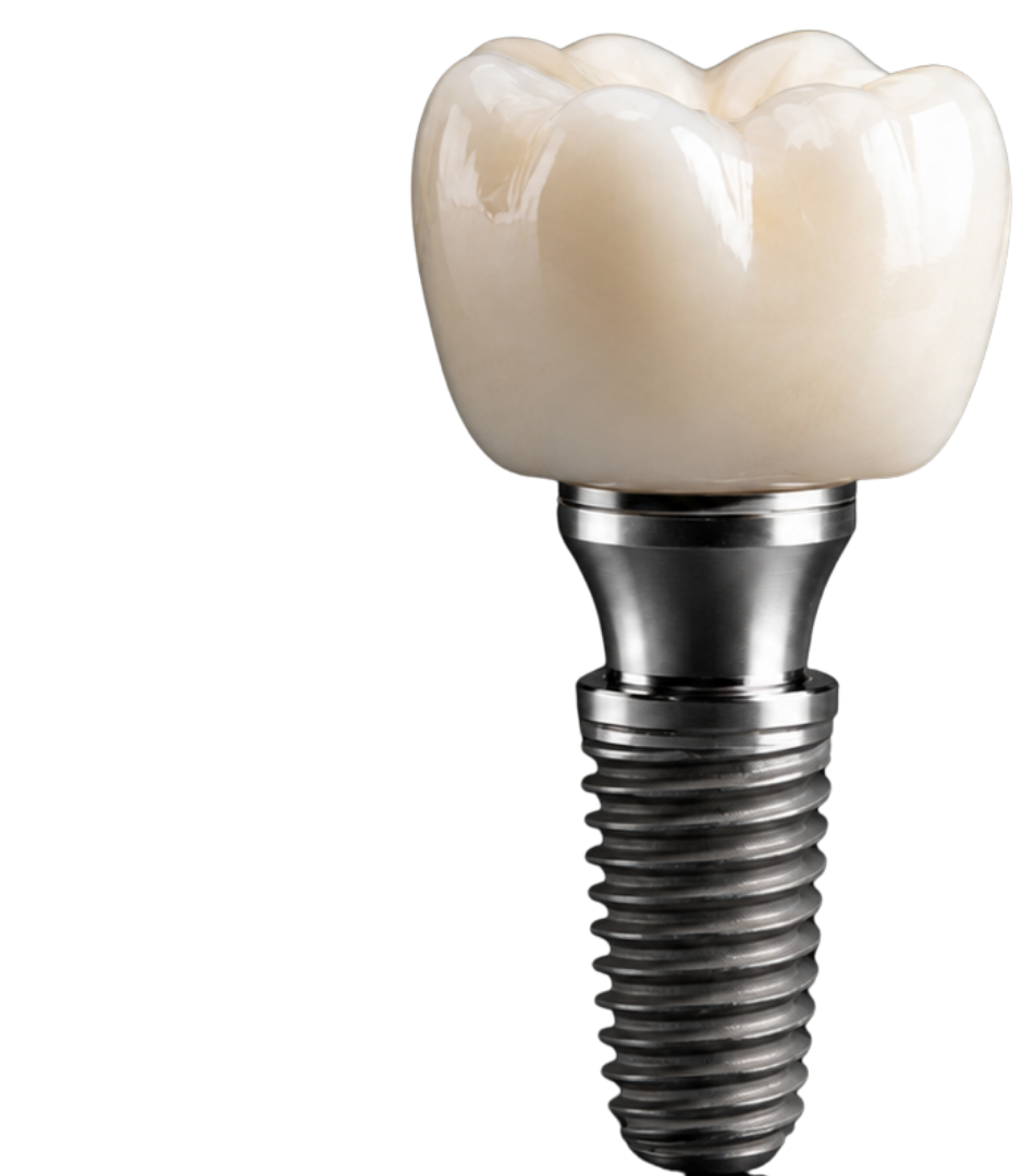 Implantes dentales clínica Nagua Dental